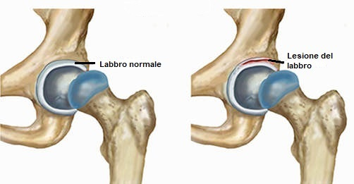 anatomia labbro acetabolare