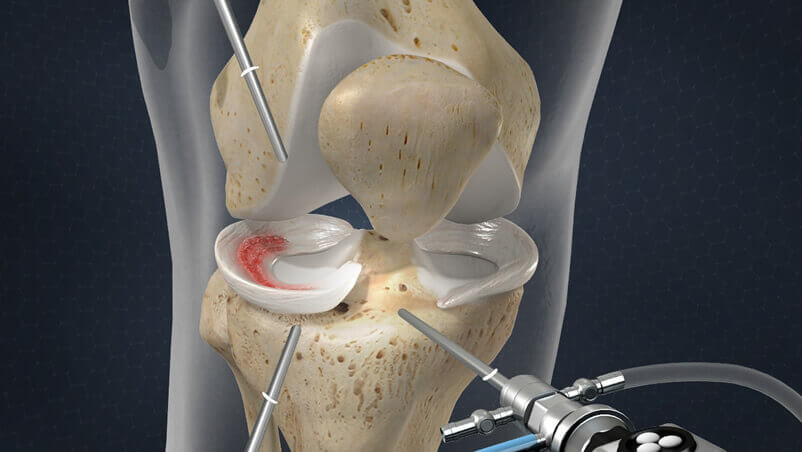 intervento chirurgico artroscopia menisco ginocchio