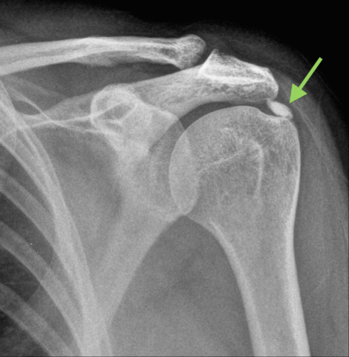 radiografia calcificazione alla spalla
