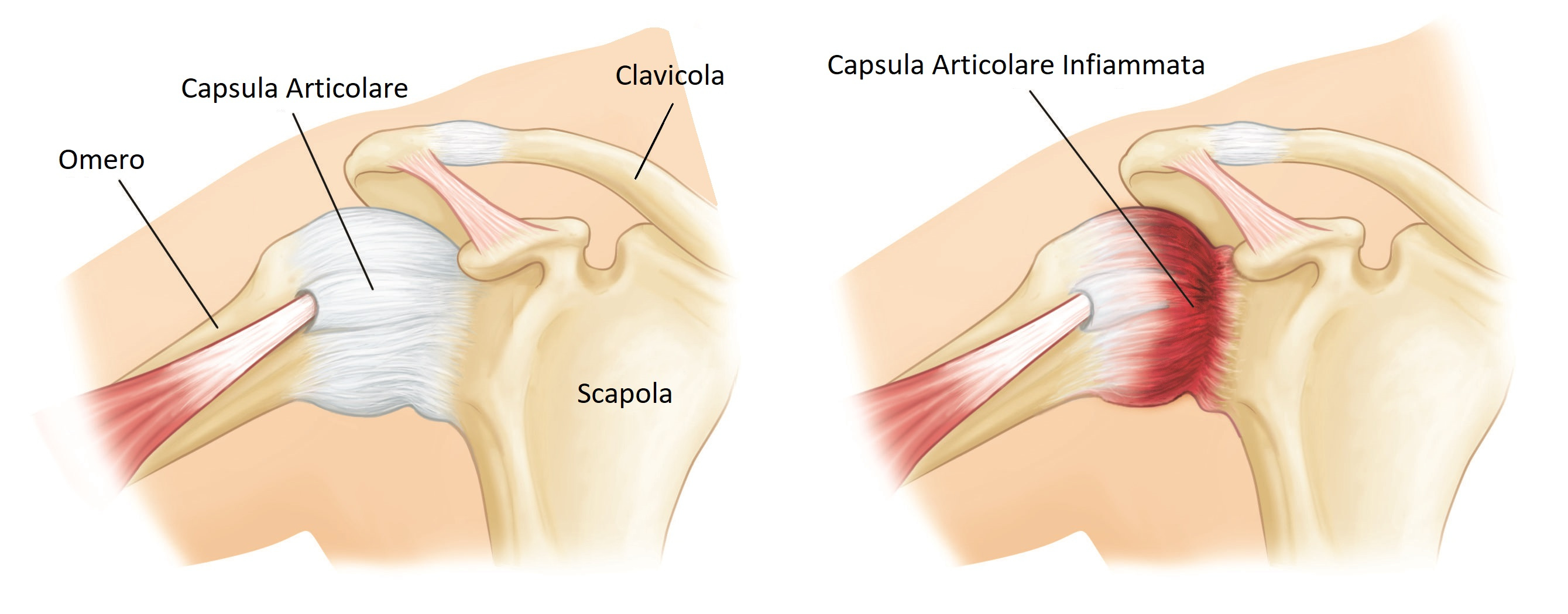 spalla congelata infiammazione capsulite adesiva retrattile dolore spalla